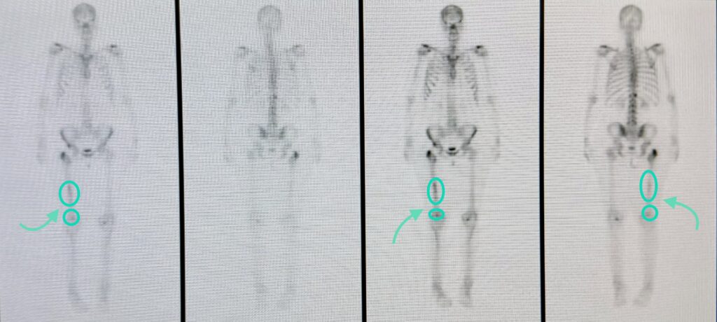 Bone scintigraphy (bone scan) showing anterior and posterior views. Teal markers highlight two areas of increased radiotracer uptake in the right femur and knee region.